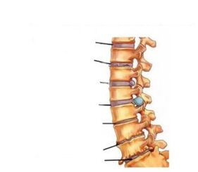 أعراض هشاشة العظم