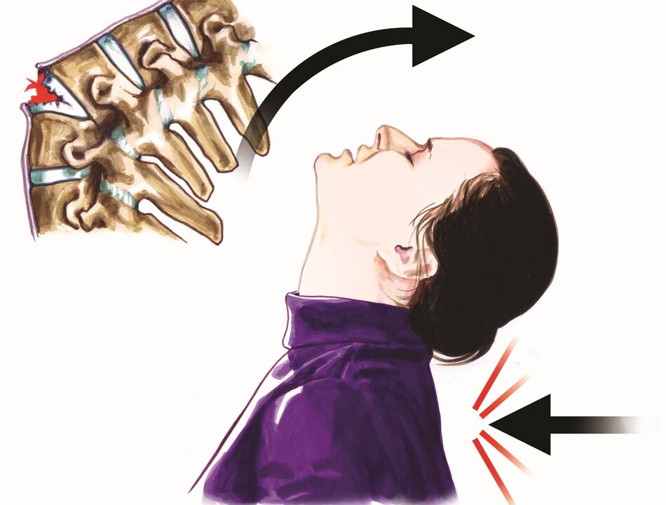 تلف العمود الفقري كسبب لآلام الرقبة.
